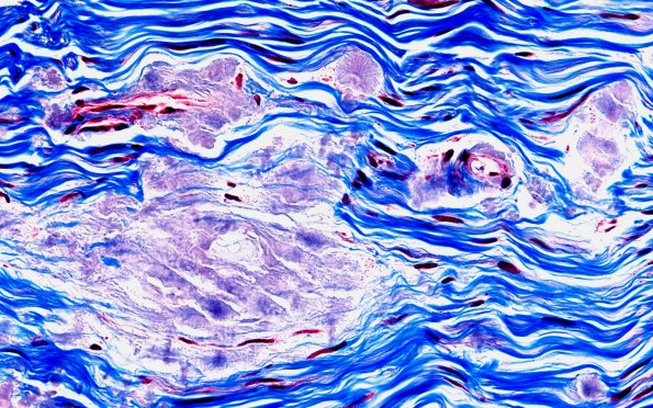 1B2 Amyloid (Case 1) Trichrome 60X
