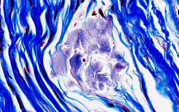 1B4 Amyloid (Case 1) Trichrome 100X 2