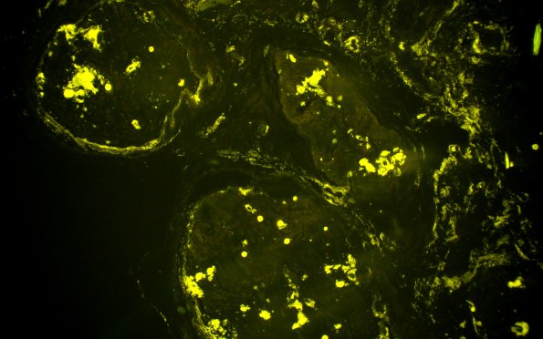 1C3 Amyloid (Case 1) Thio-S Image_04 - Copy | 14 AMYLOID NEUROPATHY ...