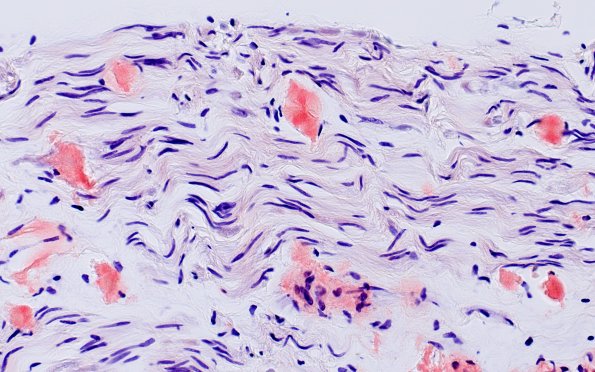 1D1A Amyloid (Case 1) CongoRed 40X non-POL