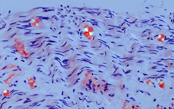 1D1B Amyloid (Case 1) CongoRed 40X POL