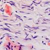 1D2A Amyloid (Case 1) CongoRed 60X non-POL