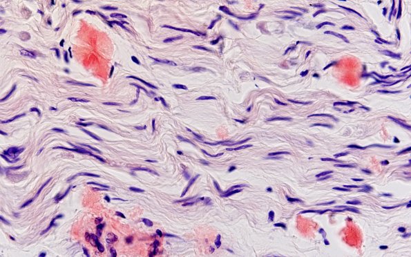 1D2A Amyloid (Case 1) CongoRed 60X non-POL