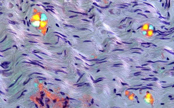 1D2B Amyloid (Case 1) CongoRed 60X POL