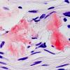 1D3A Amyloid (Case 1) CongoRed 100X non-POL