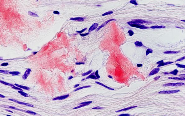 1D3A Amyloid (Case 1) CongoRed 100X non-POL