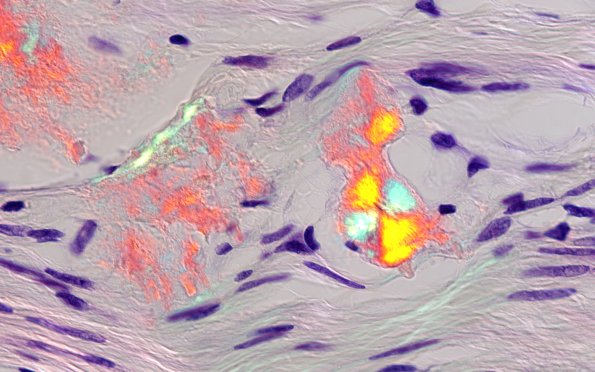 1D3B Amyloid (Case 1) CongoRed 100X POL