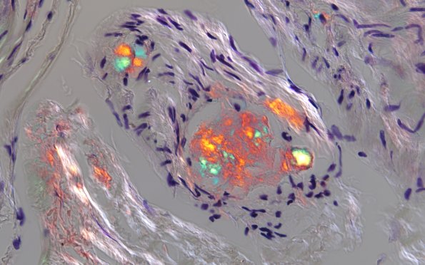 1D4B Amyloid (Case 1) CongoRed 60X POL 5