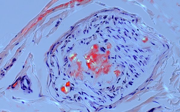 1D5B Amyloid (Case 1) CongoRed 40X POL 4