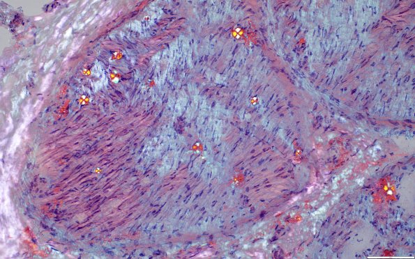 1D6B (Case 1) ALH amyloid - CR-P 200xc
