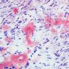 1D7A (Case 1) ALH amyloid - CR 400x
