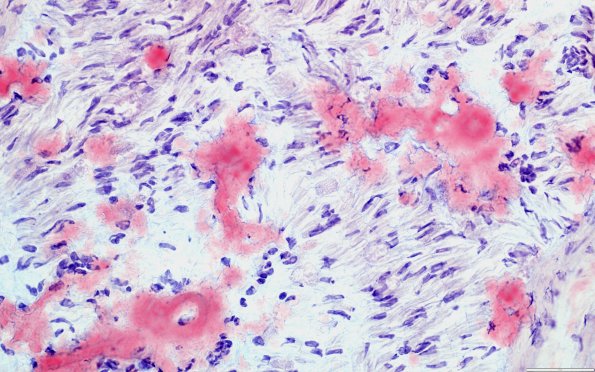 1D7A (Case 1) ALH amyloid - CR 400x