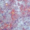 1D7B (Case 1) ALH amyloid - CR-P 400x