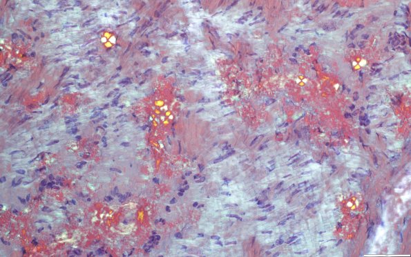 1D7B (Case 1) ALH amyloid - CR-P 400x
