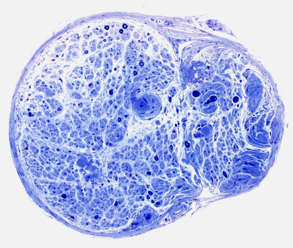 1E2 Amyloid (Case 1) Plastic 20X 2