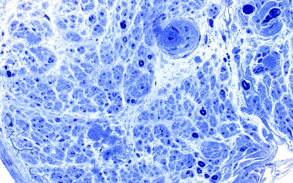 1E3 Amyloid (Case 1) Plastic 40X 1