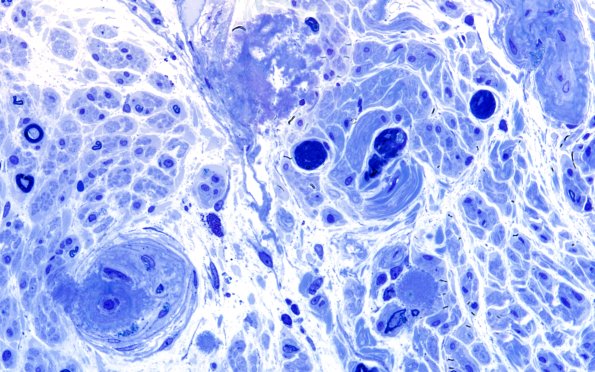 1E4 Amyloid (Case 1) Plastic 60X 2