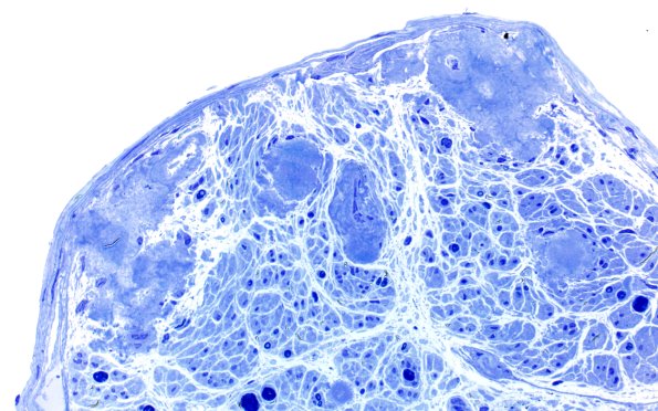 1E5 Amyloid (Case 1) Plastic 60X 1