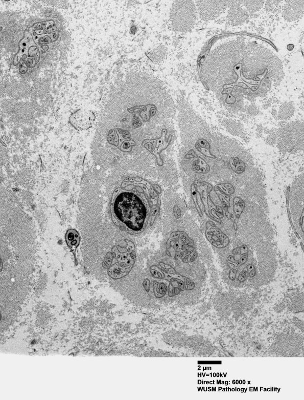 1F1 (Case 1) Nerve_019 - Copy