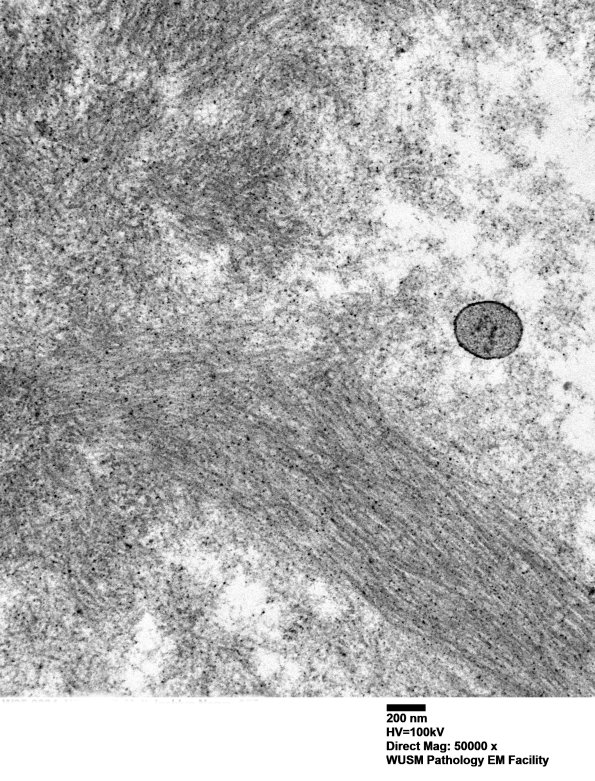 1F11 (Case 1) Nerve_055 - Copy