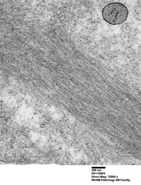 1F12 (Case 1) Nerve_056 - Copy