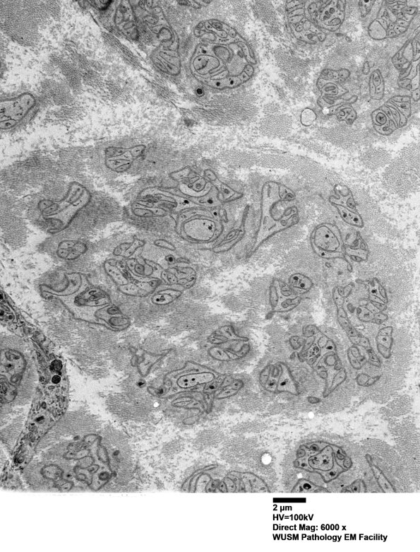 1F2 (Case 1) Nerve_020 - Copy