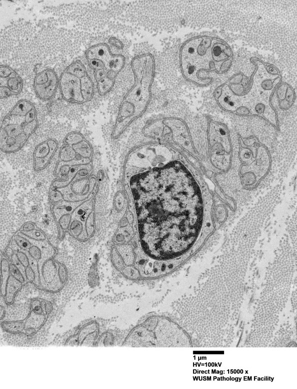 1F3 (Case 1) Nerve_046 - Copy