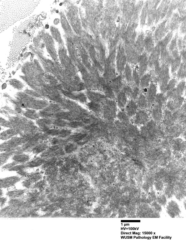 1F5 (Case 1) Nerve_074 - Copy