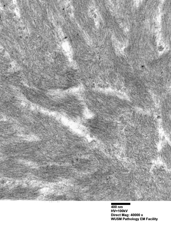 1F6 (Case 1) Nerve_075 - Copy