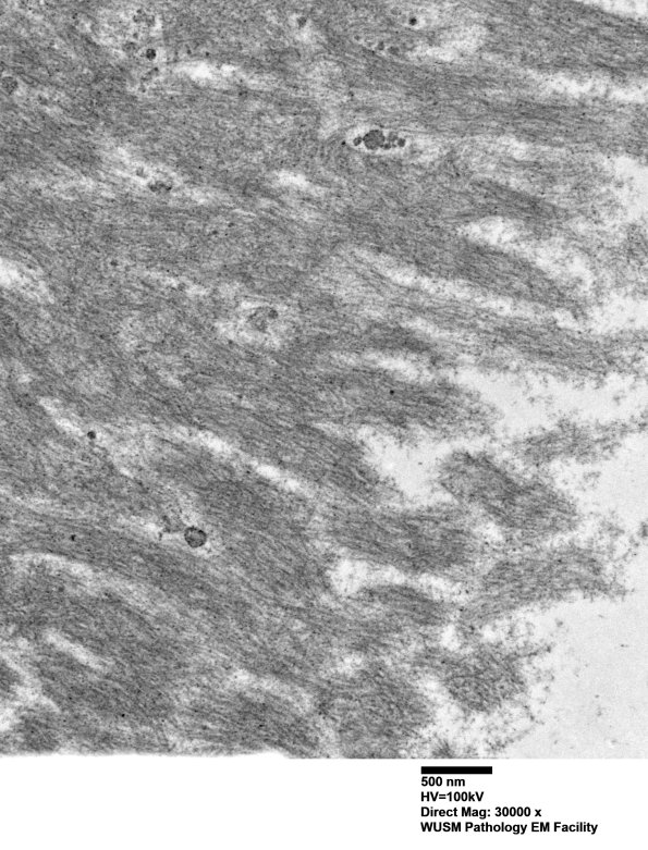 1F8 (Case 1) Nerve_026 - Copy