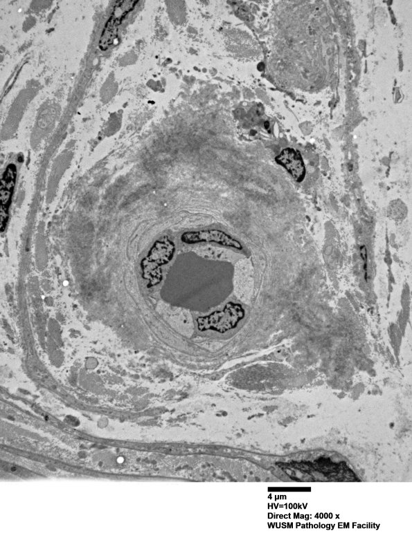 1G1 (Case 1) Nerve_058 - Copy