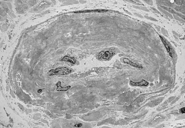 1G3 (Case 1) Nerve_068 - Copy
