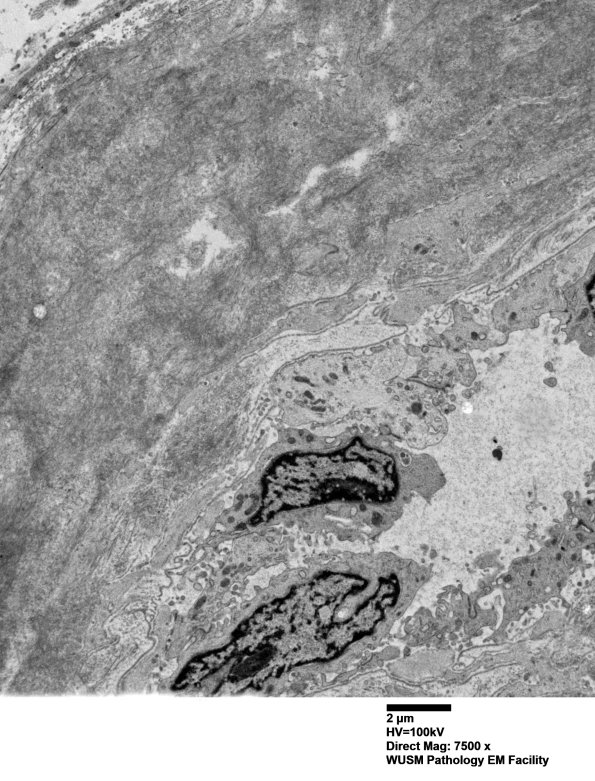 1G4 (Case 1) Nerve_070 - Copy