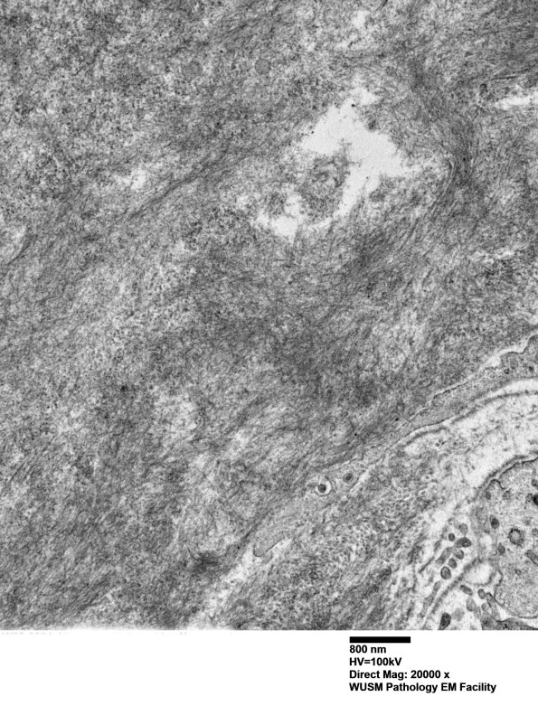 1G5 (Case 1) Nerve_071 - Copy