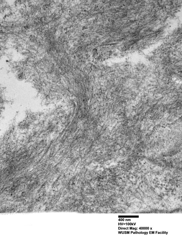 1G6 (Case 1) Nerve_072 - Copy