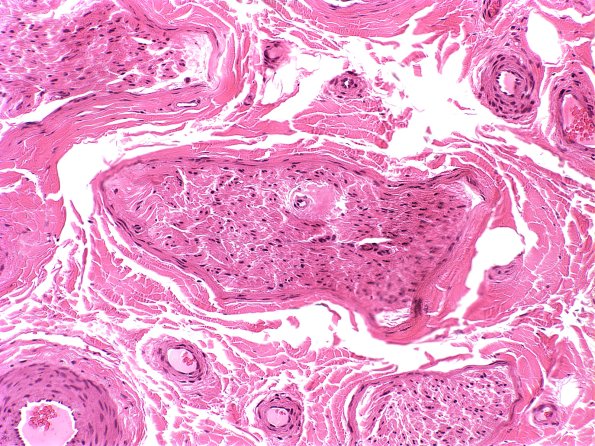 21A1 Amyloid neuropathy (Case 21) H&E 1