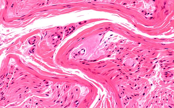 21A2 Amyloid neuropathy (Case 21) H&E 40X