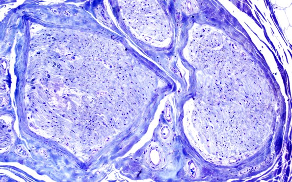 21B Amyloid neuropathy (Case 21) Plastic 20X 2
