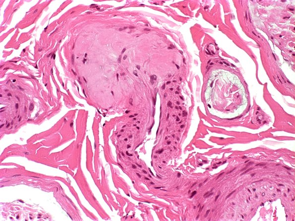 22A1 Amyloid neuropathy (Case 22) H&E 1