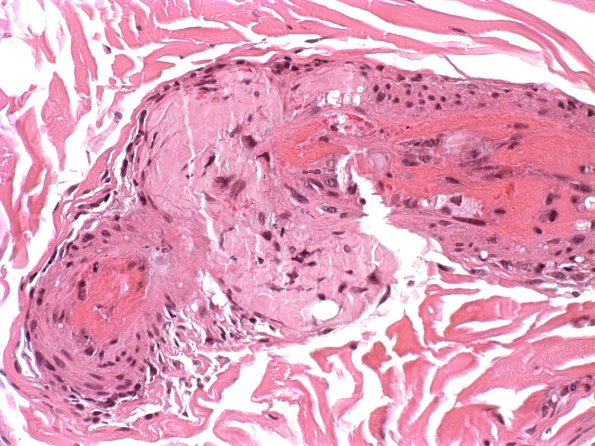 22A2 Amyloid neuropathy (Case 22) H&E 2