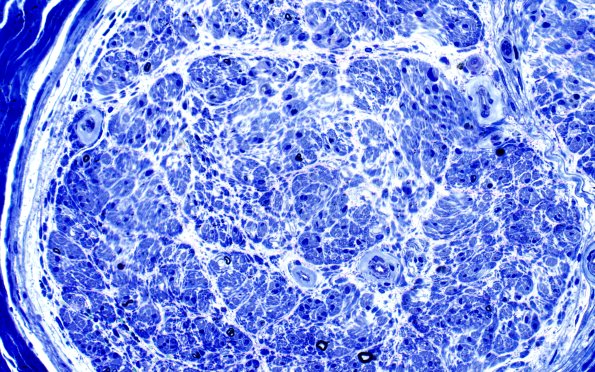 22B1 Amyloid neuropathy (Case 22) Plastic 40X 1