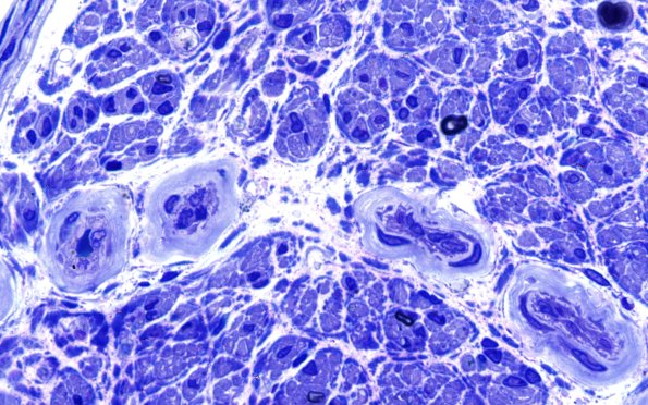 22B3 Amyloid neuropathy (Case 22) Plastic 100X 2