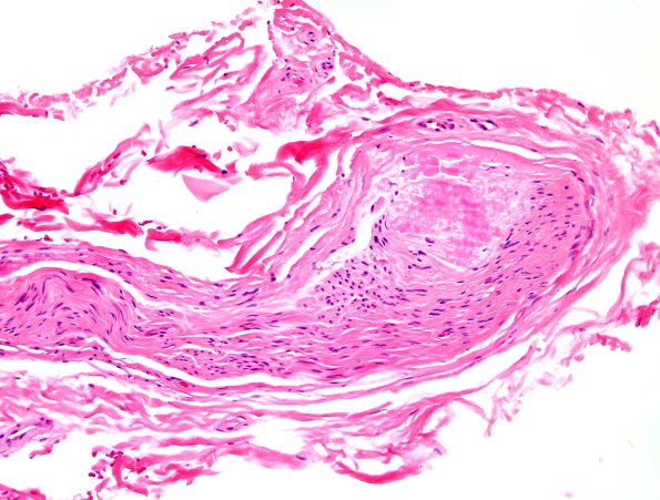23A2 Amyloid Neuropathy (Case 23) H&E 3