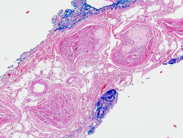 2A1 Amyloid Neuropathy (Case 2) H&E 1