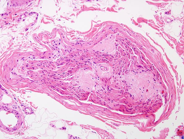 2A2 Amyloid Neuropathy (Case 2) H&E 3