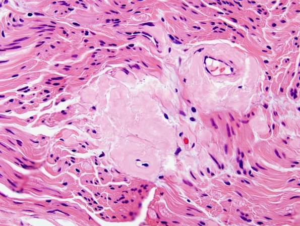2A3 Amyloid Neuropathy (Case 2) H&E 2