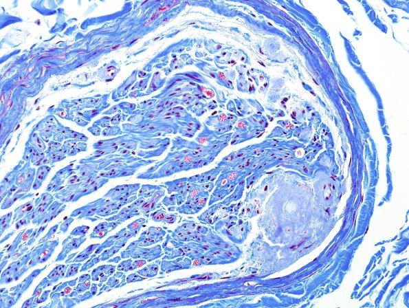 2B1 Amyloid Neuropathy (Case 2) Trichrome 6