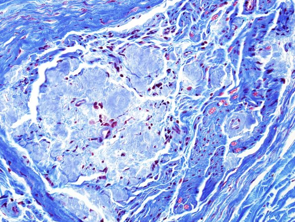 2B2 Amyloid Neuropathy (Case 2) Trichrome 4