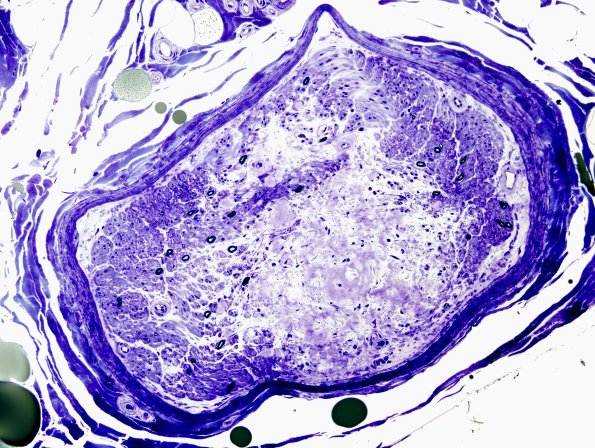 2E1 Amyloid Neuropathy (Case 2) Plastic 2