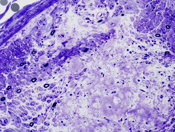 2E2 Amyloid Neuropathy (Case 2) Plastic 1
